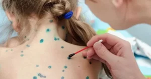 Спалах вітрянки у Полтаві: понад 100 захворілих