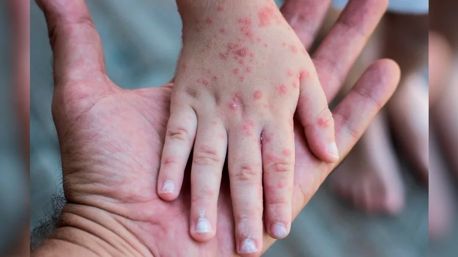 Випадки інфекцій на Полтавщині: від менінгіту до сальмонельозу